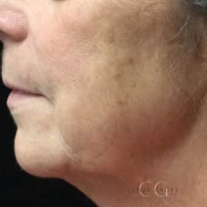 After Image: IPL and Skin Pigmentation