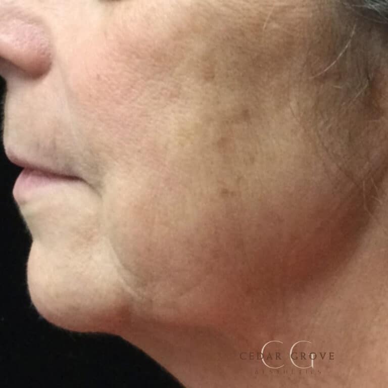 After Image: IPL and Skin Pigmentation - left-side