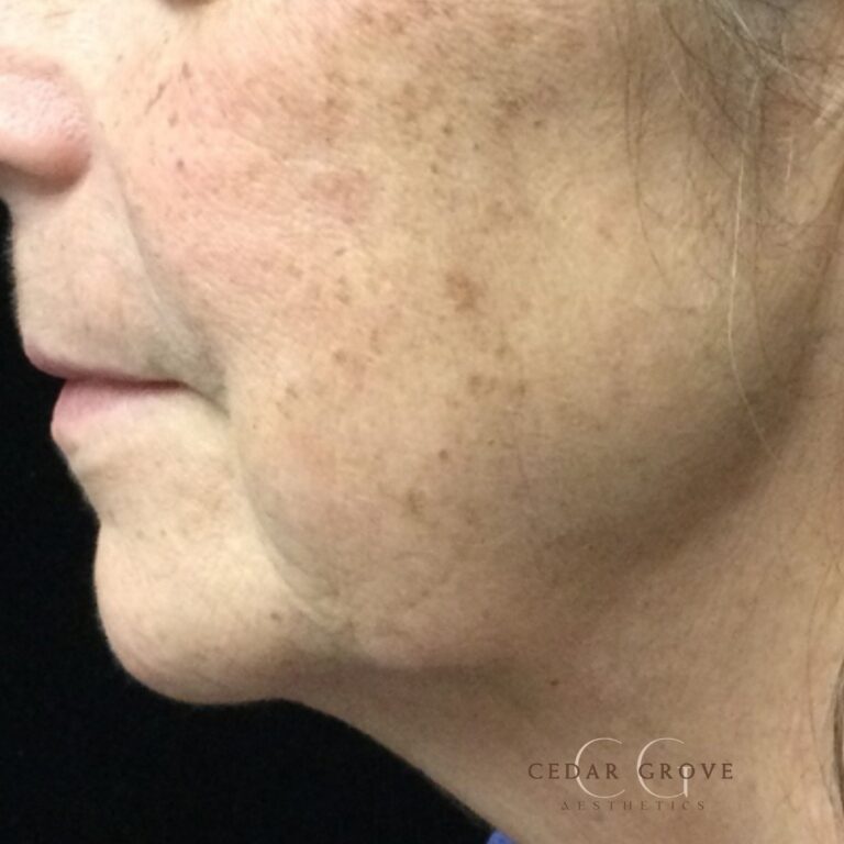 Before Image: IPL and Skin Pigmentation - left-side