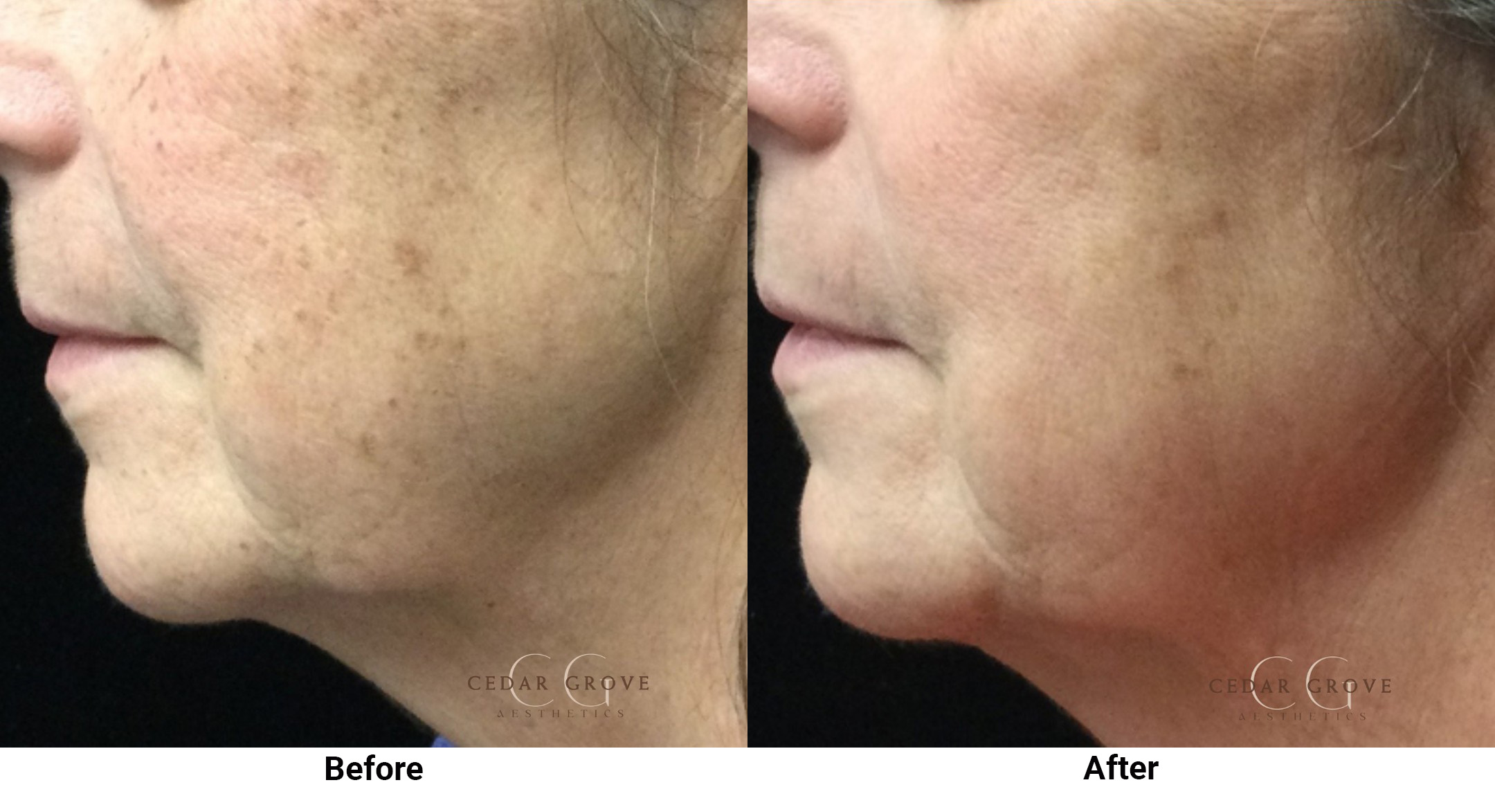 Before and after IPL Photofacial Smyrna TN