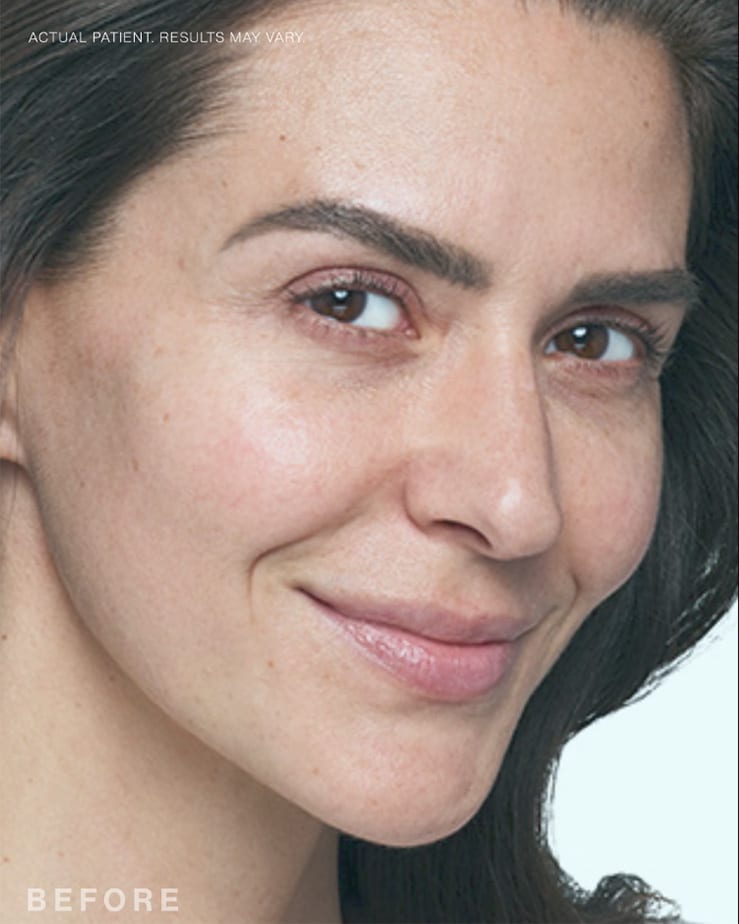 Before Image: Skinvive - right-front-oblique